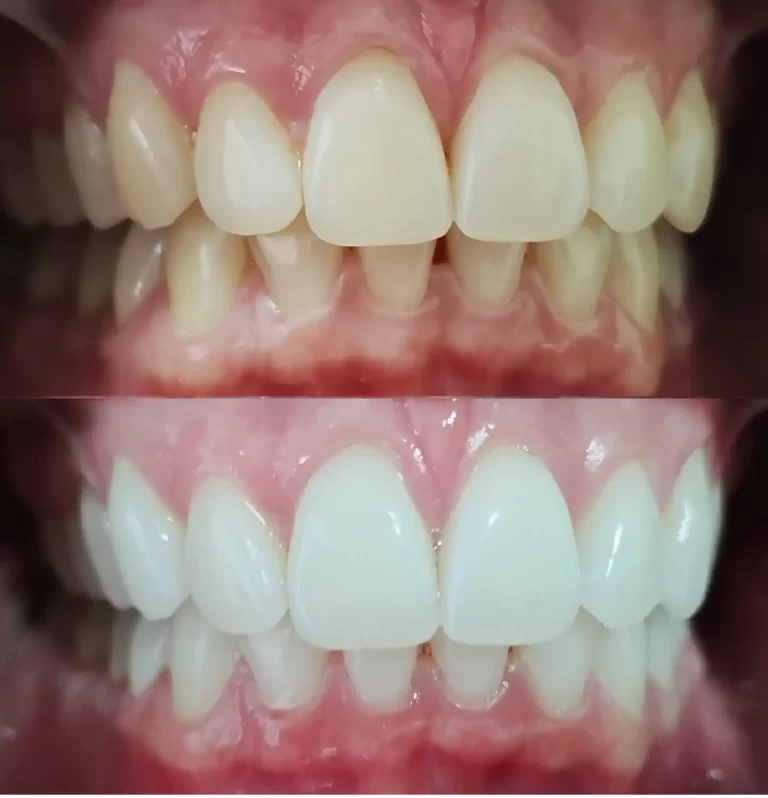 Clareamento dental em Barbacena