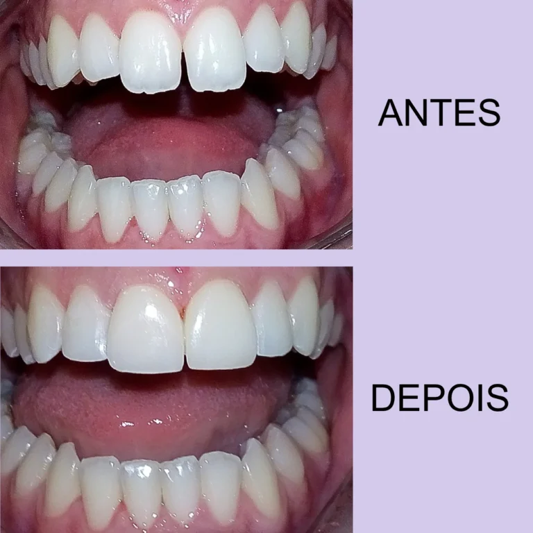 Facetas de porcelana