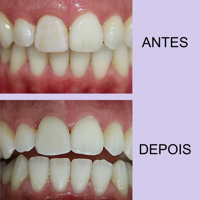 Facetas de porcelana